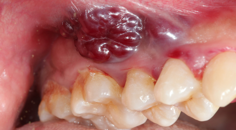 Cheek/Mouth Lining Cancer Surgery