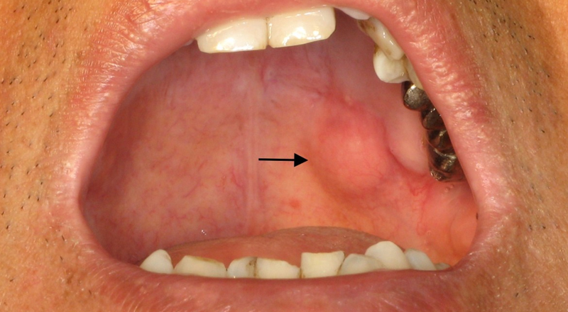 Upper Jaw/Palate Cancer Surgery