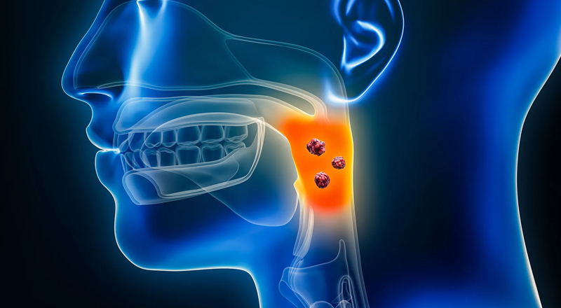 Tonsil & Throat Cancer Surgery