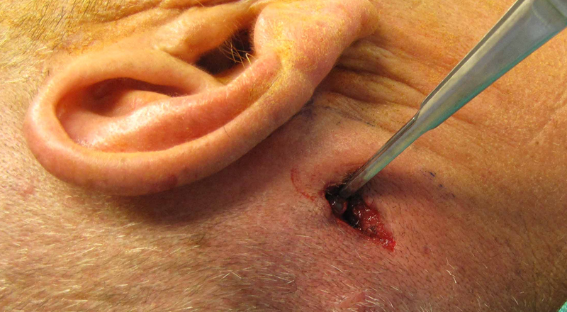 Sentinel Lymph Node Biopsy for Skin Cancer
