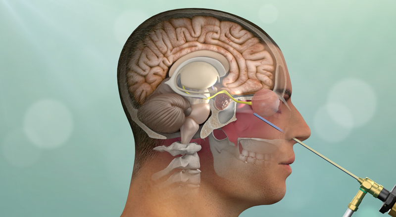 Skull Base Tumor Surgery