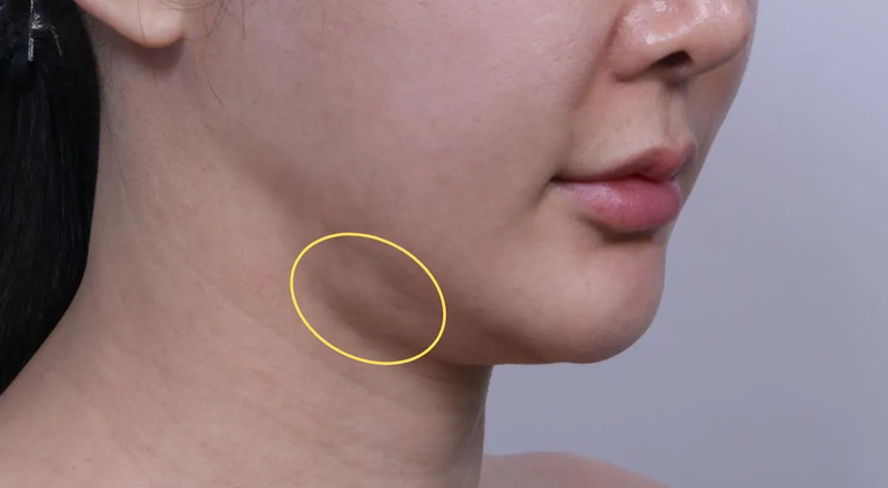 Submandibular Gland Excision
