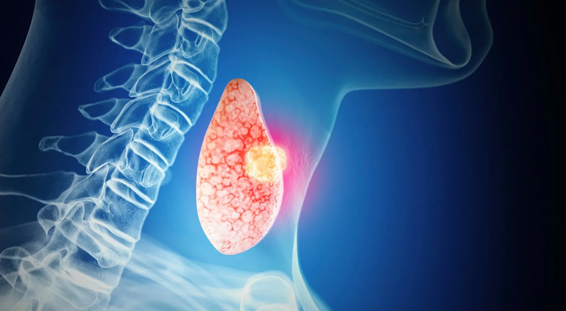 Thyroid Cancer with Lymph Node Surgery