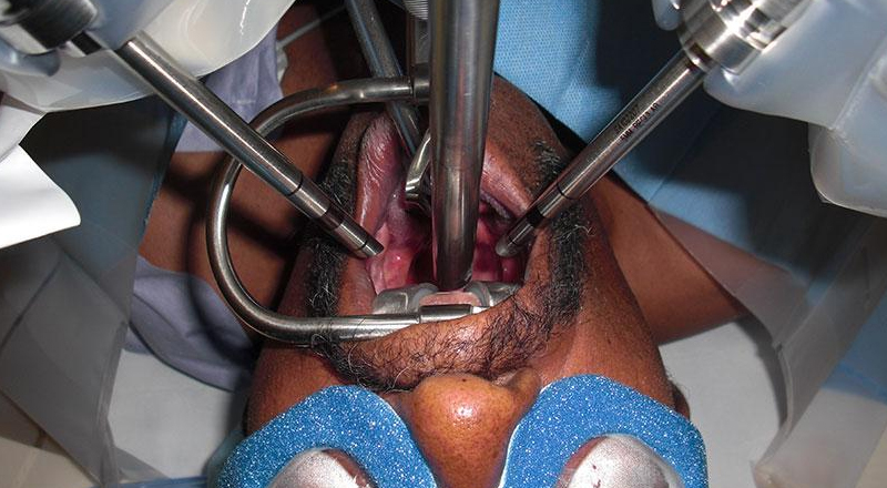 Minimally Invasive Throat Cancer Surgery