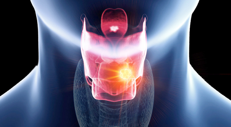 Tracheoesophageal Puncture & Voice Prosthesis